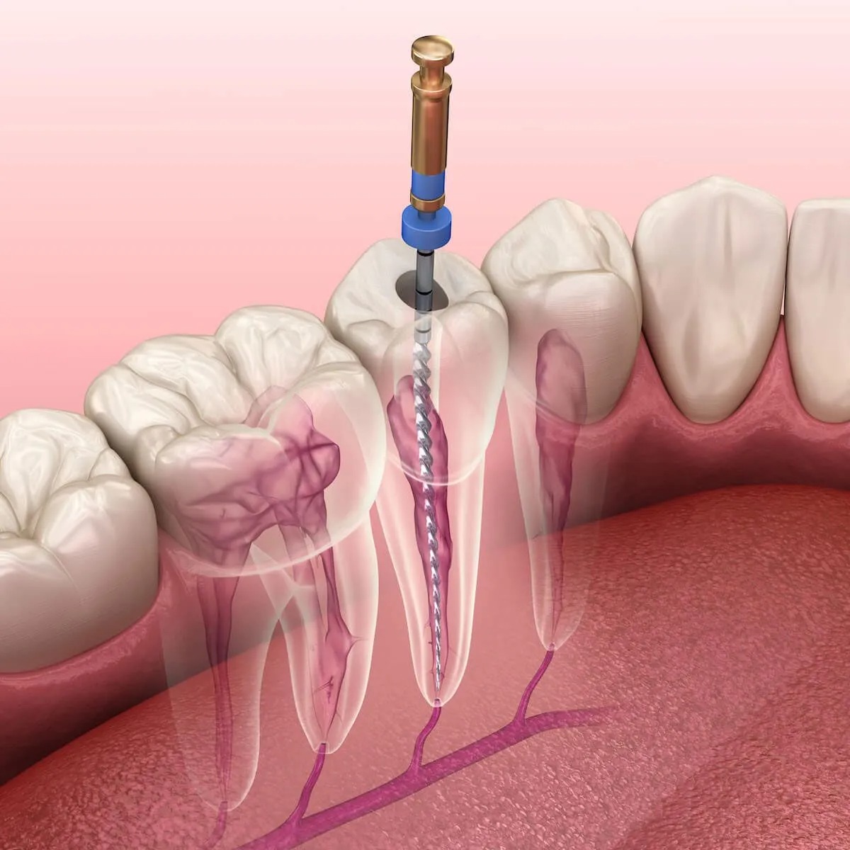 endodonzia